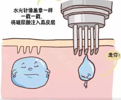 水光针