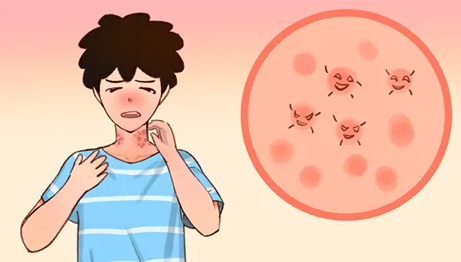 荨麻疹
