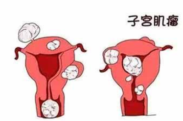 子宫肌瘤