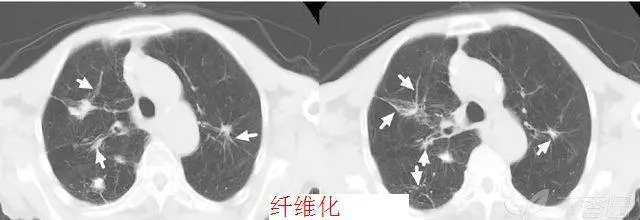 三型肺结核是什么严重吗？治疗有希望吗？