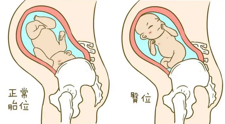 孕晚期胎动看男女准确吗？