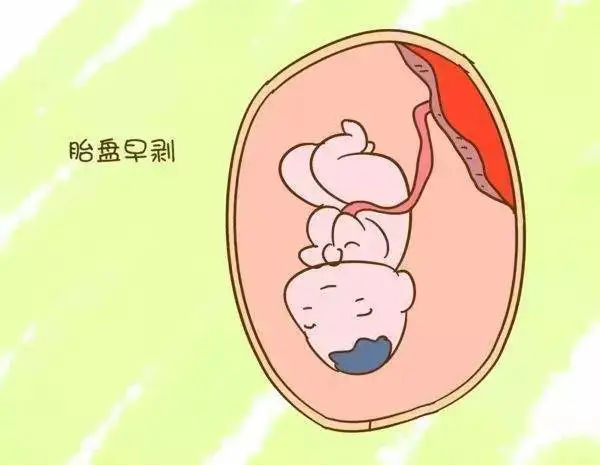 怀孕三个月死胎反应是什么？