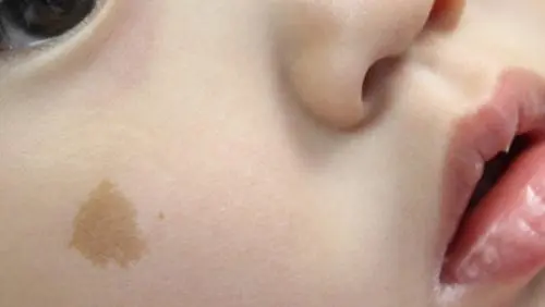 怎么分辨是不是婴儿咖啡斑？