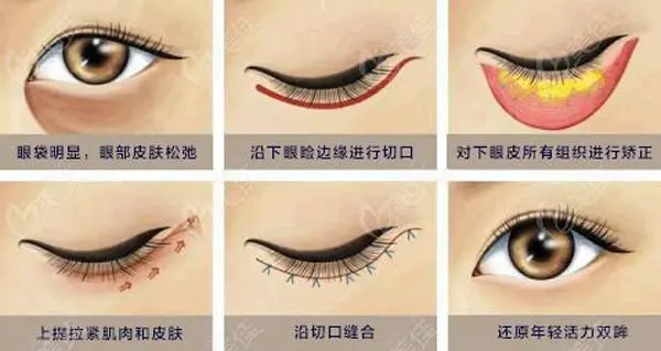 去医院割眼袋有哪些风险要面对？