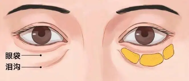 眼袋是泪沟吗？如何有效消除脸部眼袋？