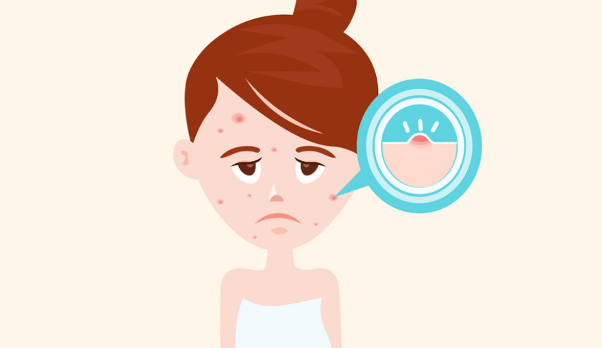 青春痘有救了吗？听说青春痘也有疫苗了？